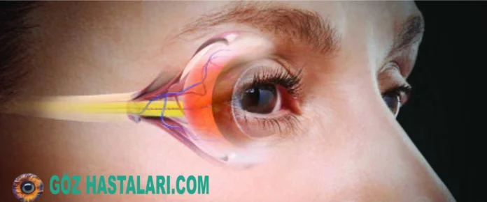 glokom-goz-tansiyonu-belirtileri-tedavisi